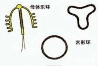 上环的利与弊全面解析