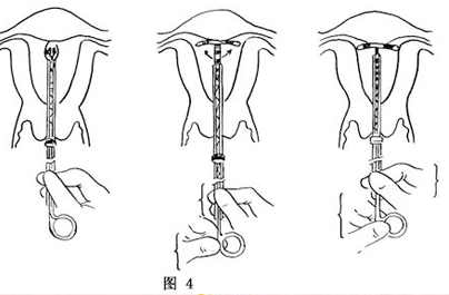 关于节育环的类型你了解多少