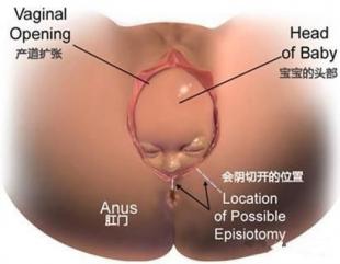 顺产侧切是什么意思
