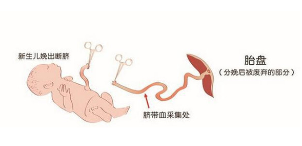 保存脐带血的利弊
