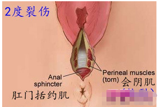 怎么预防产道裂伤