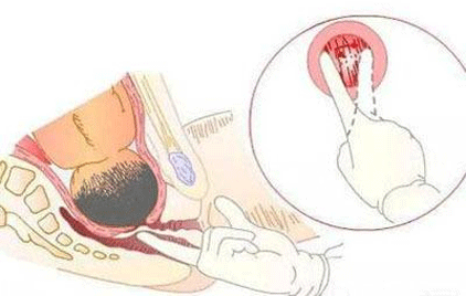开宫口快速方法