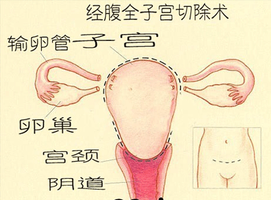 切除子宫有什么影响