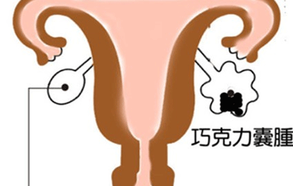 囊肿的危害