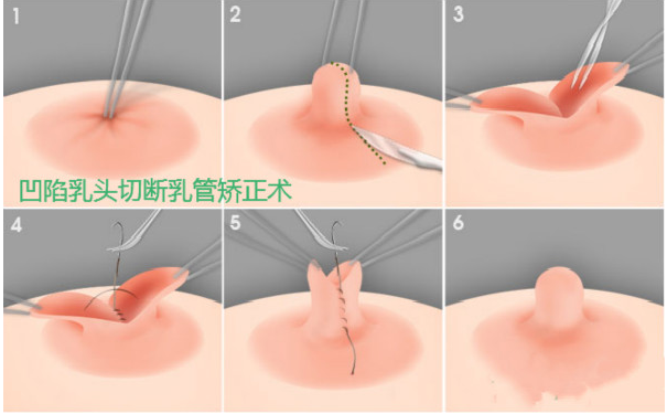 乳头内陷的治疗方法乳头内陷的预防