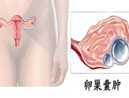 卵巢囊肿影响生育吗