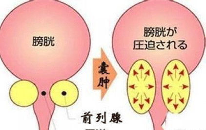 囊肿的危害