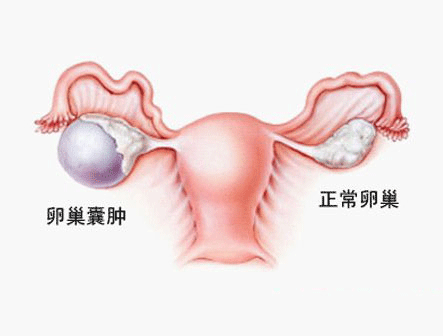 卵巢囊肿影响生育吗治疗方法有哪些