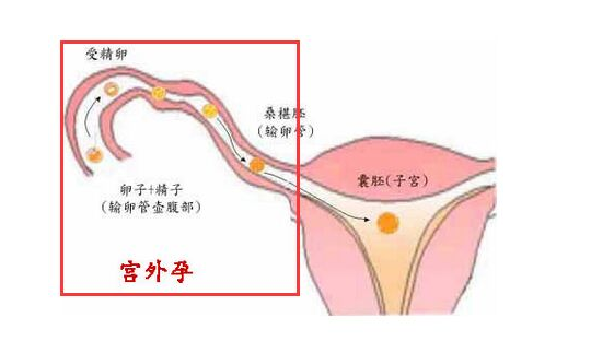 生活中注意这些让宫外孕远离我们吧