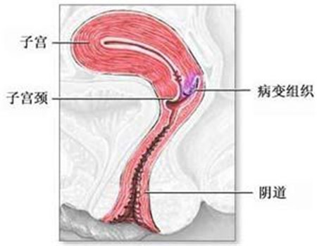尖锐湿疣检查项目有哪些 主要有八个项目