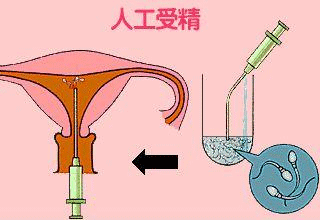 人工授精的费用