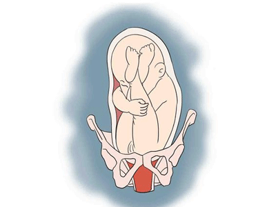 胎膜早破的危害