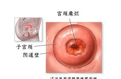 中度宫颈炎饮食禁忌