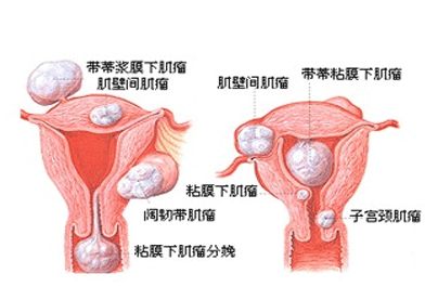 有子宫肌瘤怎么办
