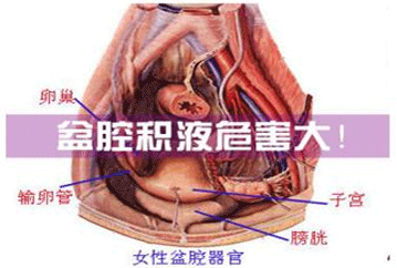 盆腔积液的护理措施
