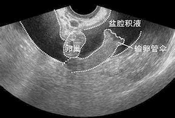盆腔积液怎么治疗