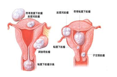 治疗子宫腺肌症选对方法最重要
