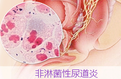 淋菌性尿道炎易发多种并发症及时治疗有效预防