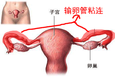 输卵管粘连的主要原因