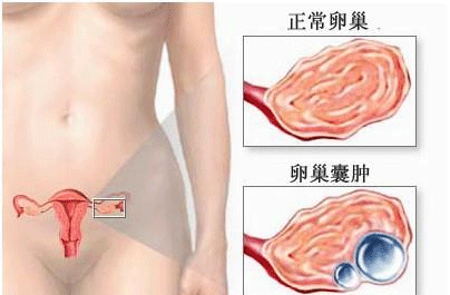卵巢囊肿破裂的症状
