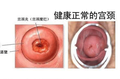 子宫炎症的症状