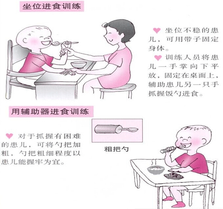 小儿脑瘫康复训练