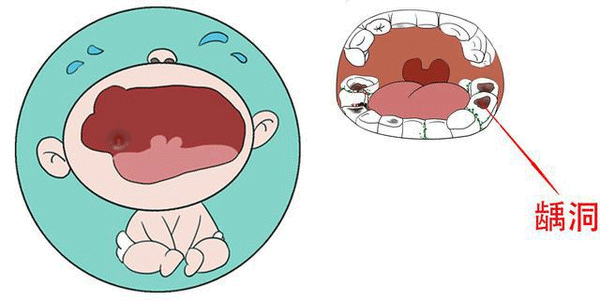 乳牙龋齿的形成原因