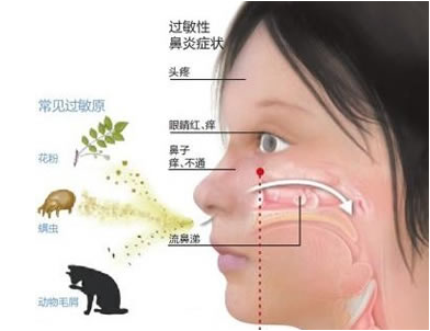 儿童鼻炎的症状