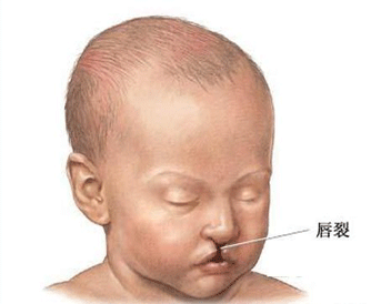 胎儿先天畸形的症状