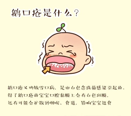 婴儿鹅口疮怎么治疗