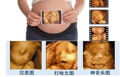 四维彩超能排除唐氏